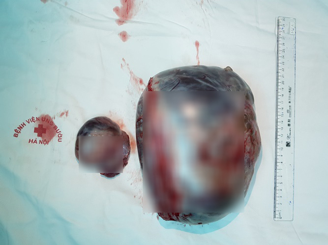 Đi điều trị xuất huyết tiêu hóa, người phụ nữ không ngờ phát hiện khối u buồng trứng "khủng" to gấp 10 lần bình thường - Ảnh 1. Đi điều trị xuất huyết tiêu hóa, người phụ nữ không ngờ phát hiện khối u buồng trứng "khủng" to gấp 10 lần bình thường - Ảnh 1.