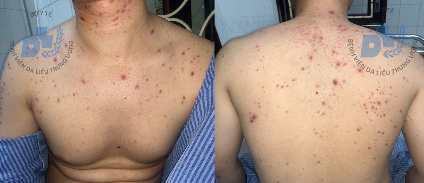 Dùng thuốc trị mụn trứng cá không rõ nguồn gốc khi mua qua facebook, nam thanh niên kinh hãi khi thấy mặt mình - Ảnh 3. Dùng thuốc trị mụn trứng cá không rõ nguồn gốc khi mua qua facebook, nam thanh niên kinh hãi khi thấy mặt mình - Ảnh 3.