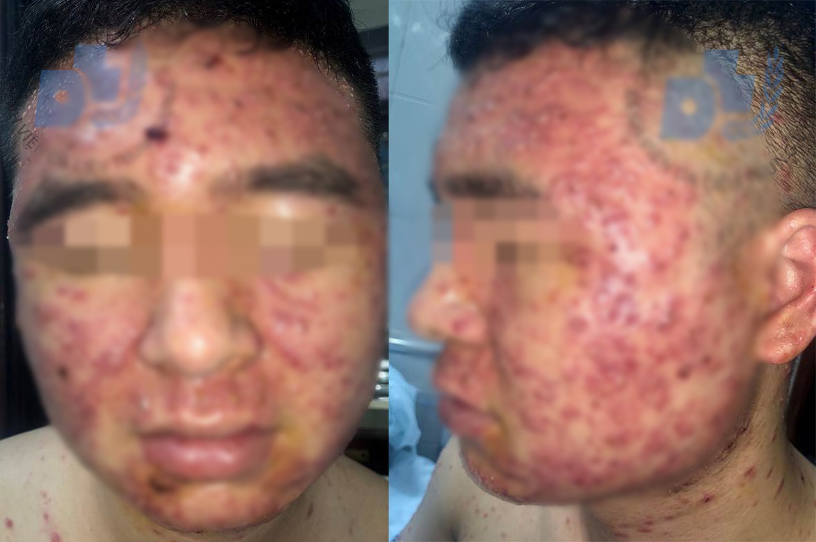 Dùng thuốc trị mụn trứng cá không rõ nguồn gốc khi mua qua facebook, nam thanh niên kinh hãi khi thấy mặt mình - Ảnh 1. Dùng thuốc trị mụn trứng cá không rõ nguồn gốc khi mua qua facebook, nam thanh niên kinh hãi khi thấy mặt mình - Ảnh 1.