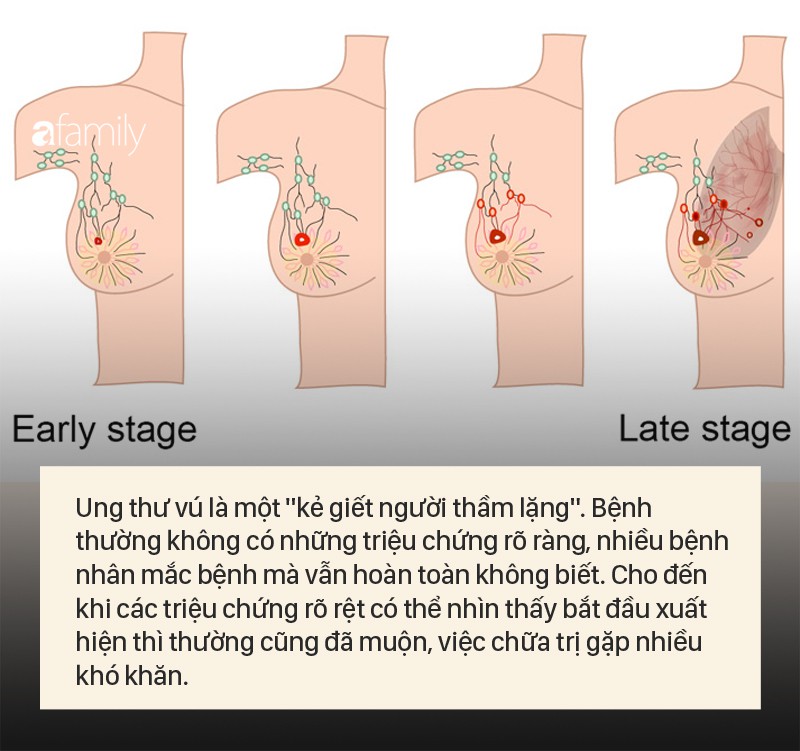 Xét nghiệm này có thể giúp phát hiện ung thư vú sớm 5 năm trước khi các triệu chứng xuất hiện - Ảnh 1. Xét nghiệm này có thể giúp phát hiện ung thư vú sớm 5 năm trước khi các triệu chứng xuất hiện - Ảnh 1.