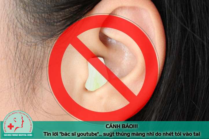 Tin lời "bác sĩ youtube" nam thanh niên suýt thủng mảng nhĩ vì nhét tỏi vào tai chữa bệnh - Ảnh 3. Tin lời "bác sĩ youtube" nam thanh niên suýt thủng mảng nhĩ vì nhét tỏi vào tai chữa bệnh - Ảnh 3.