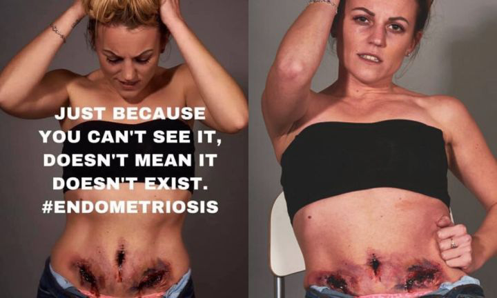 Nghe nói nhiều về bệnh lạc nội mạc tử cung rồi nhưng bạn có thực sự biết "nỗi đau chỉ trời mới thấu" này? - Ảnh 1. Nghe nói nhiều về bệnh lạc nội mạc tử cung rồi nhưng bạn có thực sự biết "nỗi đau chỉ trời mới thấu" này? - Ảnh 1.