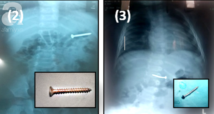 2 bé trai nuốt đinh nguy kịch trong cùng một ngày: Bác sĩ cảnh báo nguy cơ thủng ruột, tử vong - Ảnh 1. 2 bé trai nuốt đinh nguy kịch trong cùng một ngày: Bác sĩ cảnh báo nguy cơ thủng ruột, tử vong - Ảnh 1.