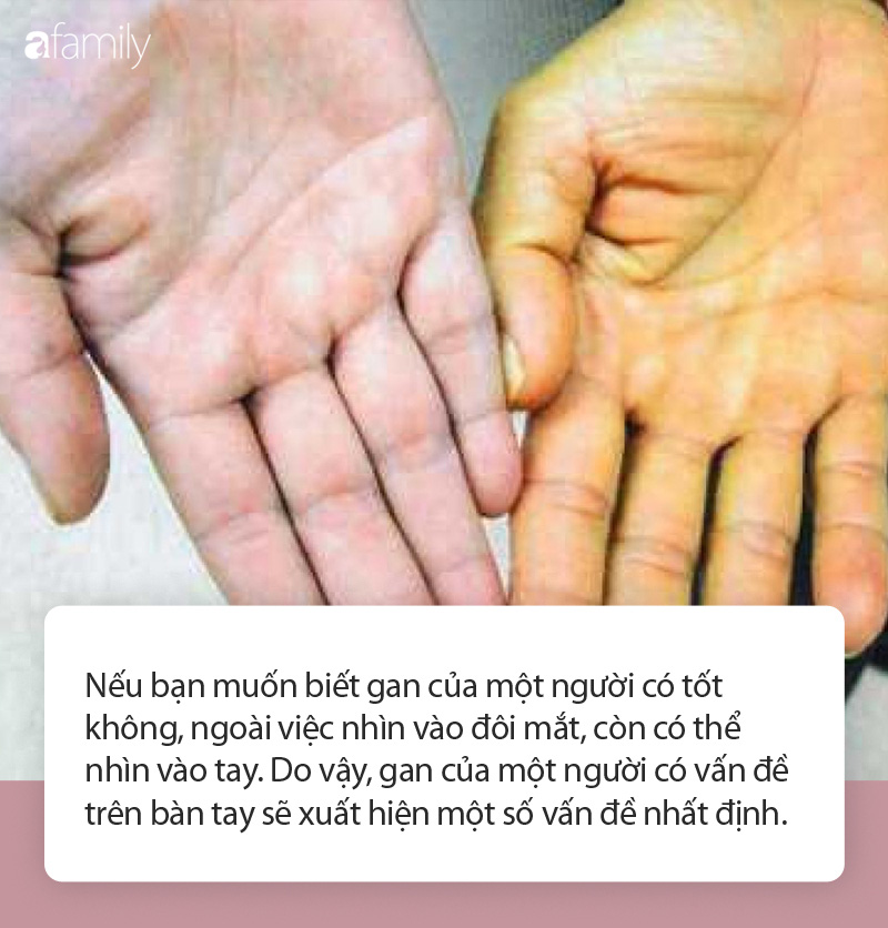 Có 3 triệu chứng này xuất hiện trên bàn tay chứng tỏ gan đang kêu cứu - Ảnh 1. Có 3 triệu chứng này xuất hiện trên bàn tay chứng tỏ gan đang kêu cứu - Ảnh 1.