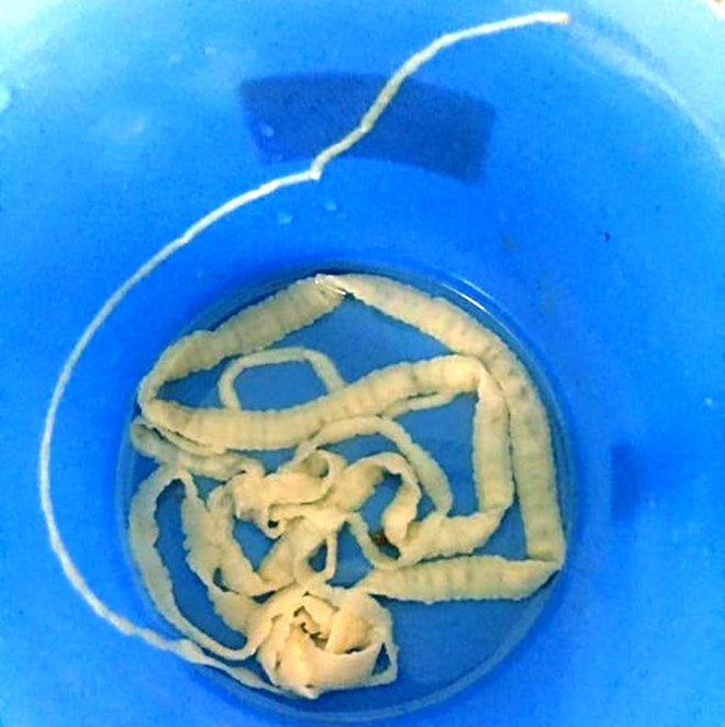 Năm 2019: Thói quen ăn đồ tái sống lên ngôi tạo điều kiện cho giun sán sinh sôi chọc thủng mắt, len vào tim, gan, trườn lên cả não... - Ảnh 4. Năm 2019: Thói quen ăn đồ tái sống lên ngôi tạo điều kiện cho giun sán sinh sôi chọc thủng mắt, len vào tim, gan, trườn lên cả não... - Ảnh 4.