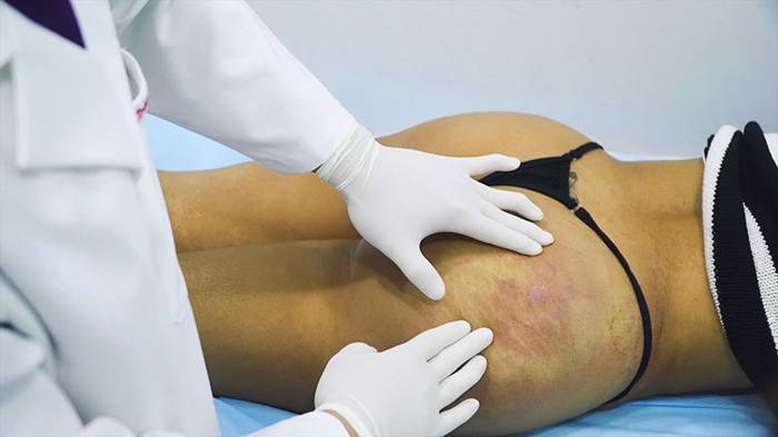 Filler – Hiểm họa từ phương pháp thẩm mĩ nội khoa khiến nhiều chị em chết mê chết mệt năm 2019 - Ảnh 5. Filler – Hiểm họa từ phương pháp thẩm mĩ nội khoa khiến nhiều chị em chết mê chết mệt năm 2019 - Ảnh 5.