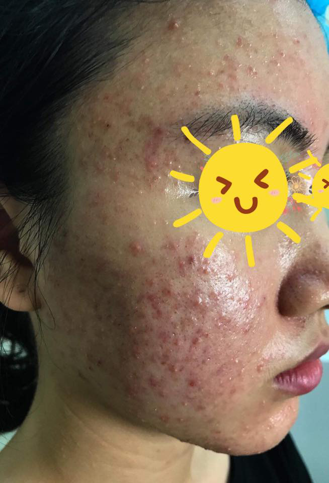 Đưa khuôn mặt "nát tươm" lên facebook diện kiến, cô gái trẻ ngậm ngùi cảnh báo thói quen làm đẹp cuối năm, chị em nào cũng cần cảnh giác cao độ! - Ảnh 2. Đưa khuôn mặt "nát tươm" lên facebook diện kiến, cô gái trẻ ngậm ngùi cảnh báo thói quen làm đẹp cuối năm, chị em nào cũng cần cảnh giác cao độ! - Ảnh 2.