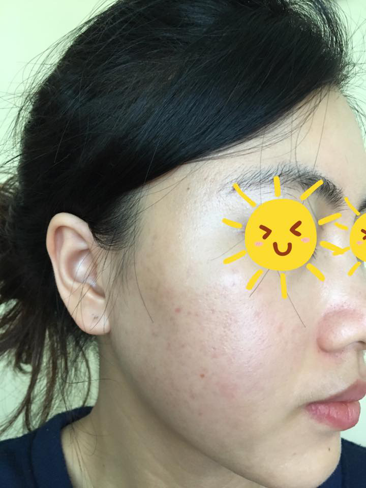 Đưa khuôn mặt "nát tươm" lên facebook diện kiến, cô gái trẻ ngậm ngùi cảnh báo thói quen làm đẹp cuối năm, chị em nào cũng cần cảnh giác cao độ! - Ảnh 5. Đưa khuôn mặt "nát tươm" lên facebook diện kiến, cô gái trẻ ngậm ngùi cảnh báo thói quen làm đẹp cuối năm, chị em nào cũng cần cảnh giác cao độ! - Ảnh 5.