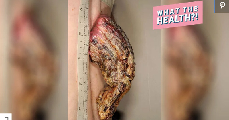 Kinh hãi chiếc "sừng rồng" trên lưng người đàn ông - hệ quả của ung thư biểu mô tế bào vảy - Ảnh 1. Kinh hãi chiếc "sừng rồng" trên lưng người đàn ông - hệ quả của ung thư biểu mô tế bào vảy - Ảnh 1.