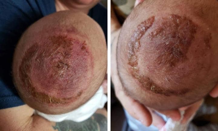 Mẹ đau thắt lòng khi con mới sinh bị thương nặng phần đầu chỉ vì bác sĩ bất chấp sử dụng cụ trợ sinh này - Ảnh 2. Mẹ đau thắt lòng khi con mới sinh bị thương nặng phần đầu chỉ vì bác sĩ bất chấp sử dụng cụ trợ sinh này - Ảnh 2.