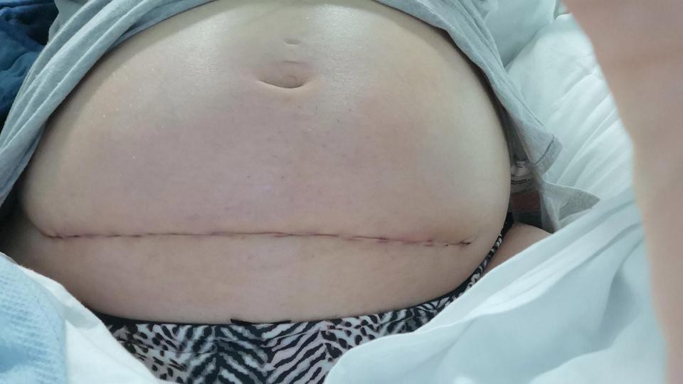 Chuyện thật như đùa: Mẹ mang thai được phẫu thuật lấy con ra ngoài để chữa bệnh, sau đó lại đưa con trở vào bụng - Ảnh 3. Chuyện thật như đùa: Mẹ mang thai được phẫu thuật lấy con ra ngoài để chữa bệnh, sau đó lại đưa con trở vào bụng - Ảnh 3.