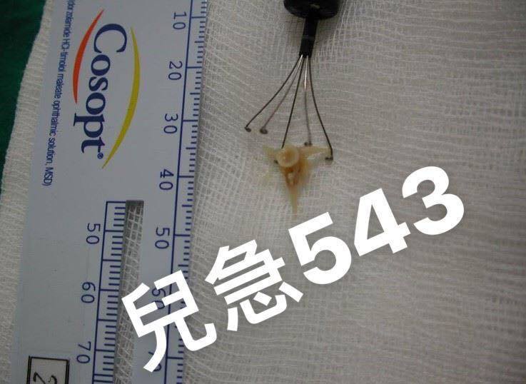 Bé 7 tháng tuổi bị rách thực quản vì món ăn phổ biến mà các bà, các mẹ thường nấu cho con ăn mỗi ngày - Ảnh 1. Bé 7 tháng tuổi bị rách thực quản vì món ăn phổ biến mà các bà, các mẹ thường nấu cho con ăn mỗi ngày - Ảnh 1.
