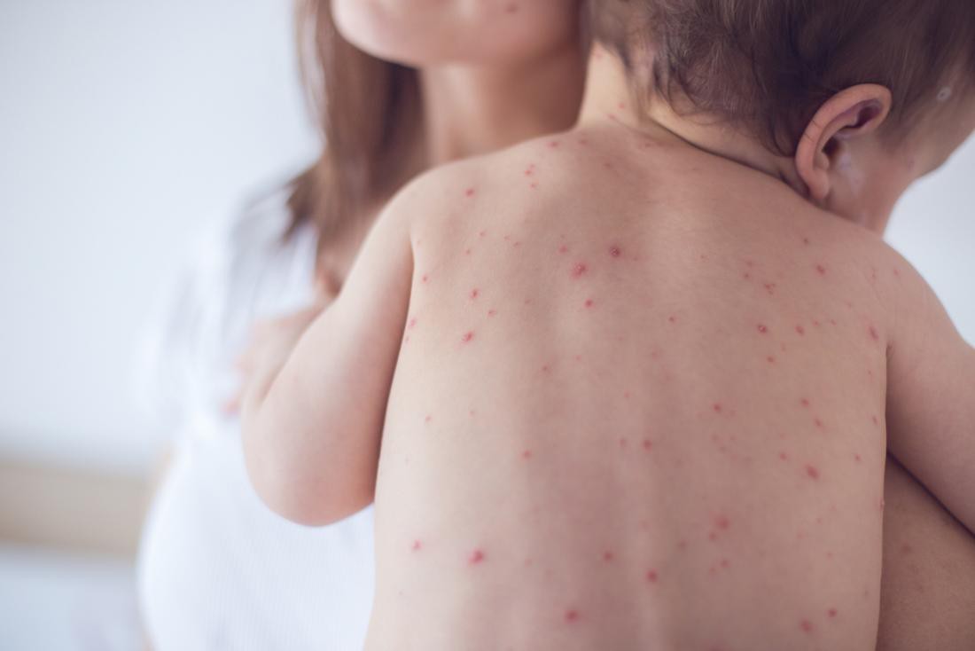 Những điều cha mẹ nên lưu ý tuyệt đối khi con mình bị mắc bệnh sởi theo lời khuyên của bác sĩ nhi khoa - Ảnh 2. Những điều cha mẹ nên lưu ý tuyệt đối khi con mình bị mắc bệnh sởi theo lời khuyên của bác sĩ nhi khoa - Ảnh 2.