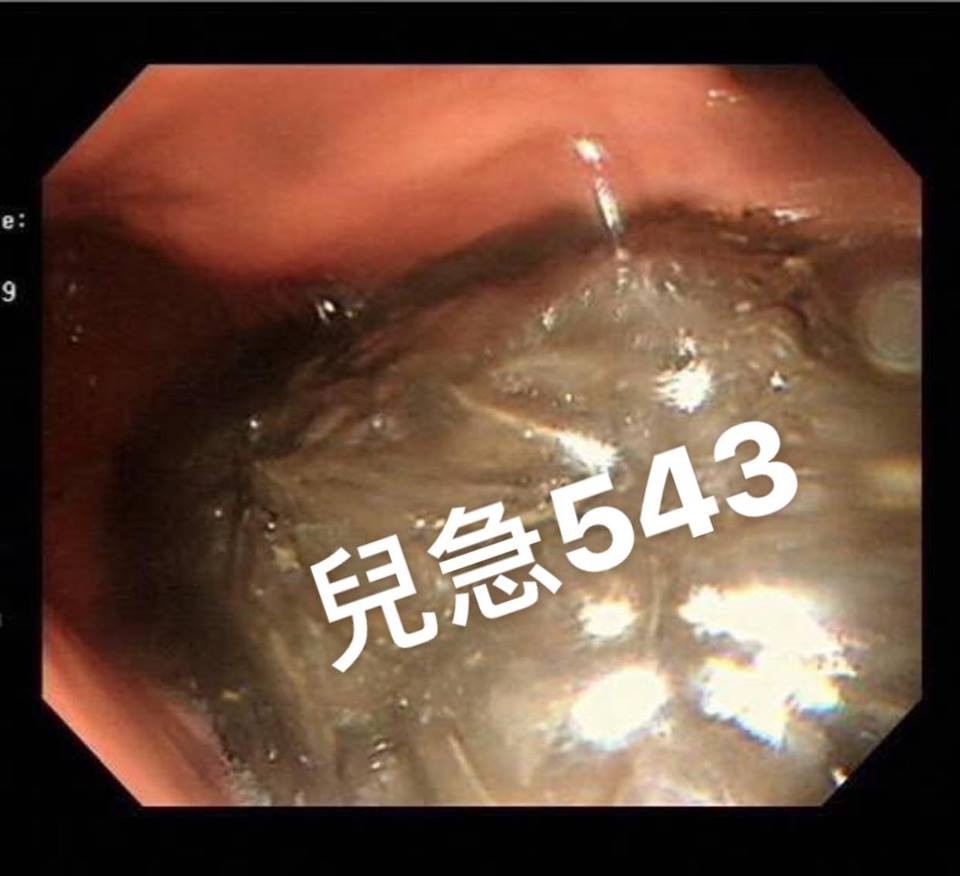 Bé trai 10 tuổi suýt chết vì sơ suất trẻ nào cũng mắc và lời cảnh báo quan trọng đến các cha mẹ ngày Tết - Ảnh 1. Bé trai 10 tuổi suýt chết vì sơ suất trẻ nào cũng mắc và lời cảnh báo quan trọng đến các cha mẹ ngày Tết - Ảnh 1.