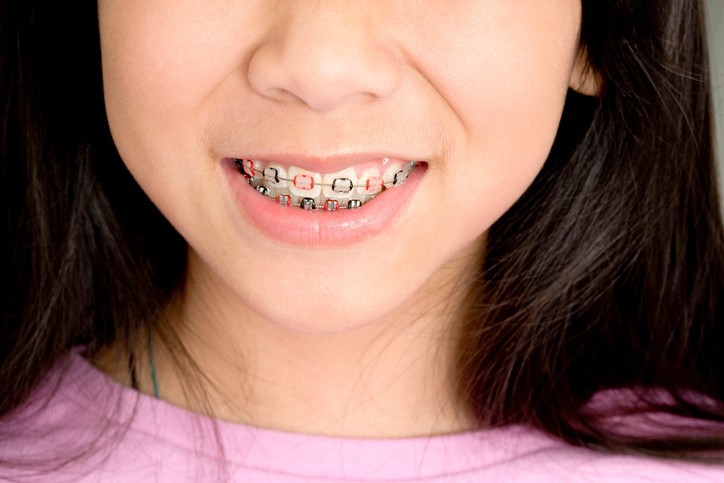 Đây là những điều cha mẹ rất nên cân nhắc trước khi quyết định cho con đi niềng răng - Ảnh 2. Đây là những điều cha mẹ rất nên cân nhắc trước khi quyết định cho con đi niềng răng - Ảnh 2.