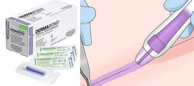 Phẫu thuật không khâu da – Giải pháp trọn vẹn cho lĩnh vực Phẫu thuật thẩm mỹ - Ảnh 2. Phẫu thuật không khâu da – Giải pháp trọn vẹn cho lĩnh vực Phẫu thuật thẩm mỹ - Ảnh 2.