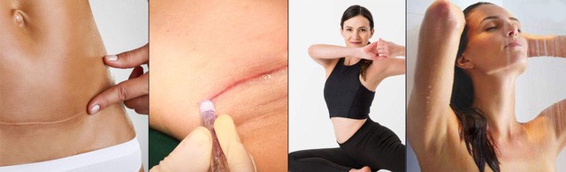 Phẫu thuật không khâu da – Giải pháp trọn vẹn cho lĩnh vực Phẫu thuật thẩm mỹ - Ảnh 4. Phẫu thuật không khâu da – Giải pháp trọn vẹn cho lĩnh vực Phẫu thuật thẩm mỹ - Ảnh 4.