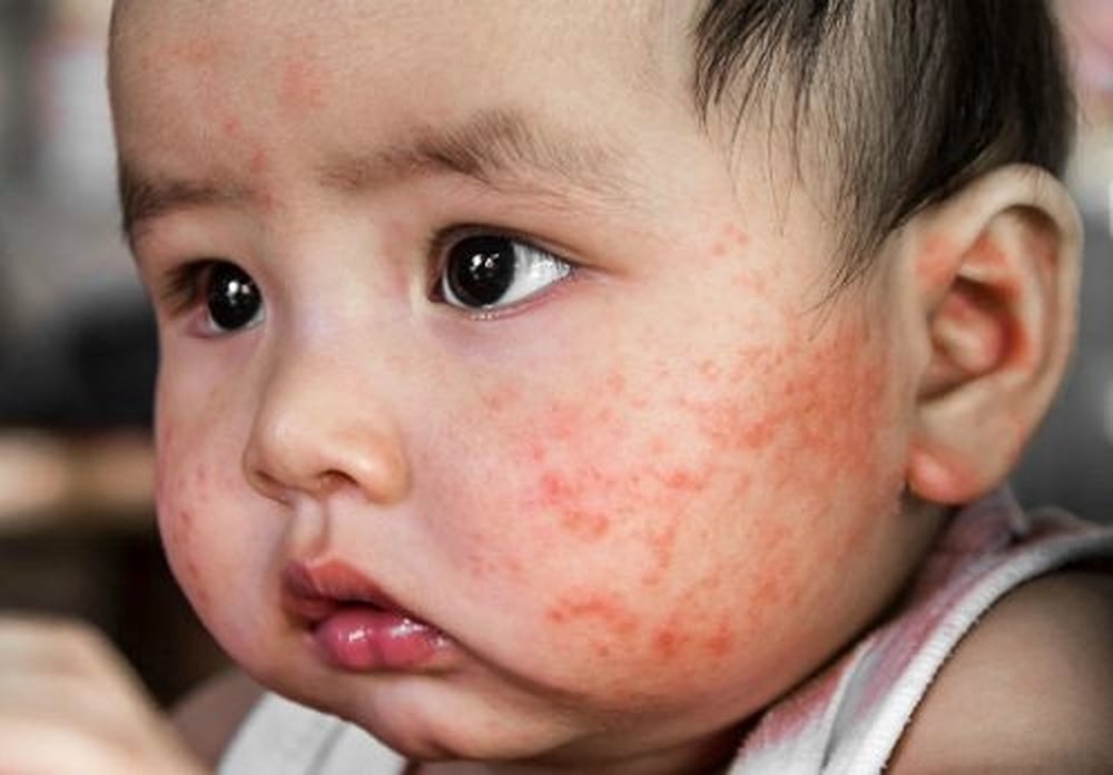 Mạng sống của con “ngàn cân treo sợi tóc” vì các mẹ nhất mực tin tưởng google hơn tin bác sĩ - Ảnh 3. Mạng sống của con “ngàn cân treo sợi tóc” vì các mẹ nhất mực tin tưởng google hơn tin bác sĩ - Ảnh 3.