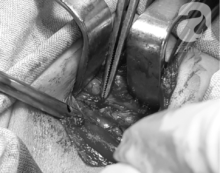 Bé trai 11 tháng tuổi thủ'sng thực quản suýt chết bởi chính món đồ chơi quen thuộc bà mẹ nào cũng dùng để dỗ con - Ảnh 5. Bé trai 11 tháng tuổi thủ'sng thực quản suýt chết bởi chính món đồ chơi quen thuộc bà mẹ nào cũng dùng để dỗ con - Ảnh 5.