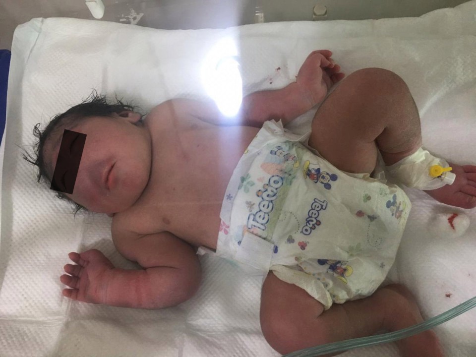 Ca sinh nở hiếm gặp chưa từng thấy: Em bé chào đời hoàn toàn không có mũi khiến ngay cả bác sĩ cũng kinh ngạc vì chưa gặp bao giờ - Ảnh 2. Ca sinh nở hiếm gặp chưa từng thấy: Em bé chào đời hoàn toàn không có mũi khiến ngay cả bác sĩ cũng kinh ngạc vì chưa gặp bao giờ - Ảnh 2.