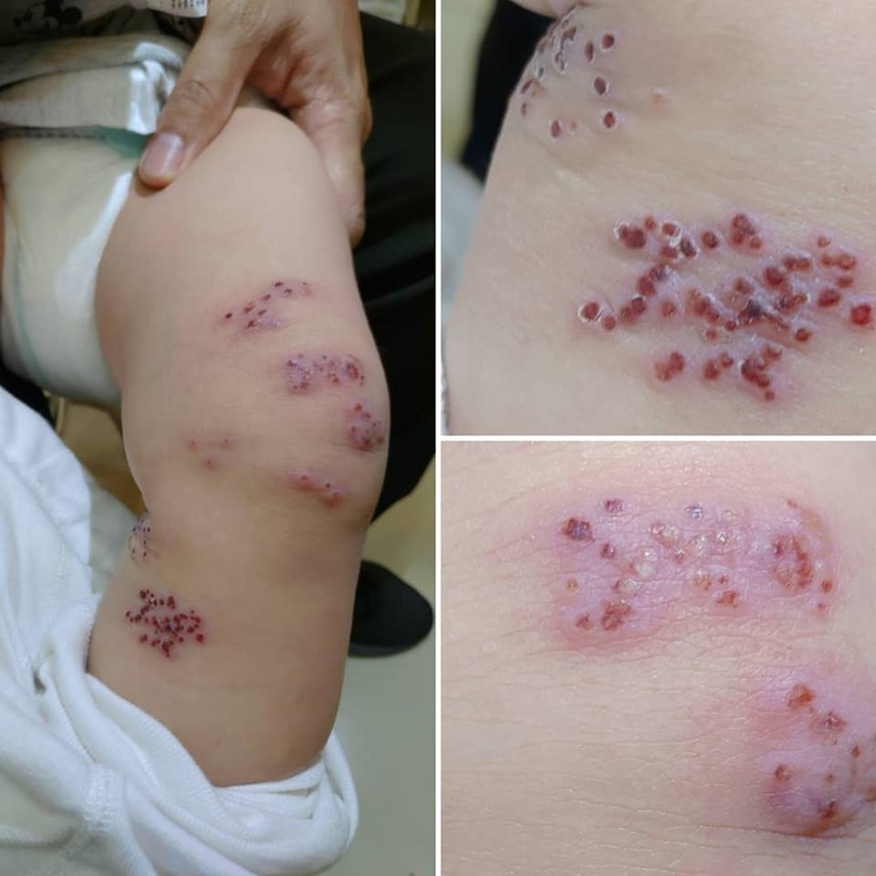 Bé 1 tuổi nổi mụn nước chi chít trông vô cùng đáng sợ ở chân, lời chẩn đoán của bác sĩ nhi khoa khiến ai nấy đều ngỡ ngàng - Ảnh 1. Bé 1 tuổi nổi mụn nước chi chít trông vô cùng đáng sợ ở chân, lời chẩn đoán của bác sĩ nhi khoa khiến ai nấy đều ngỡ ngàng - Ảnh 1.