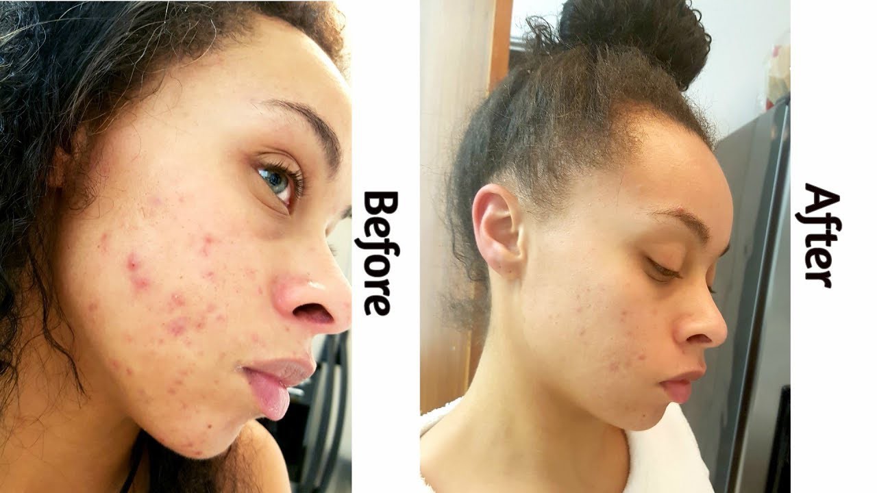 Retinoid – “siêu anh hùng” vừa giúp giảm mụn, mờ thâm lại chống lão hóa mà bác sĩ da liễu nào cũng dùng - Ảnh 19. Retinoid – “siêu anh hùng” vừa giúp giảm mụn, mờ thâm lại chống lão hóa mà bác sĩ da liễu nào cũng dùng - Ảnh 19.