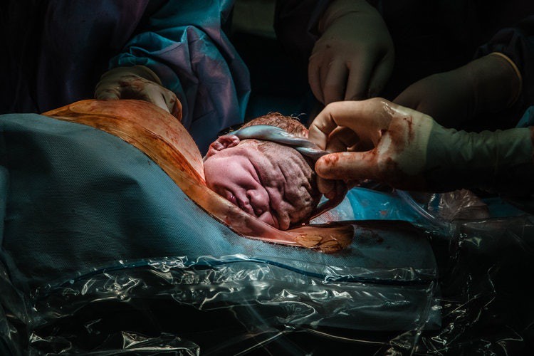 Chùm ảnh xúc động về những ca sinh mổ cho ta thấy các bà mẹ mới là những chiến binh thực thụ trên đời - Ảnh 10. Chùm ảnh xúc động về những ca sinh mổ cho ta thấy các bà mẹ mới là những chiến binh thực thụ trên đời - Ảnh 10.