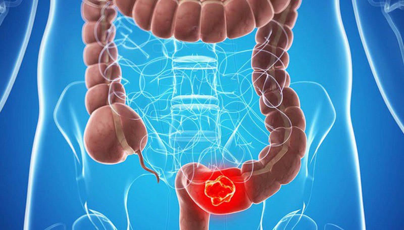 Các triệu chứng ung thư đại trực tràng rất dễ bị bỏ qua - Ảnh 4. Các triệu chứng ung thư đại trực tràng rất dễ bị bỏ qua - Ảnh 4.