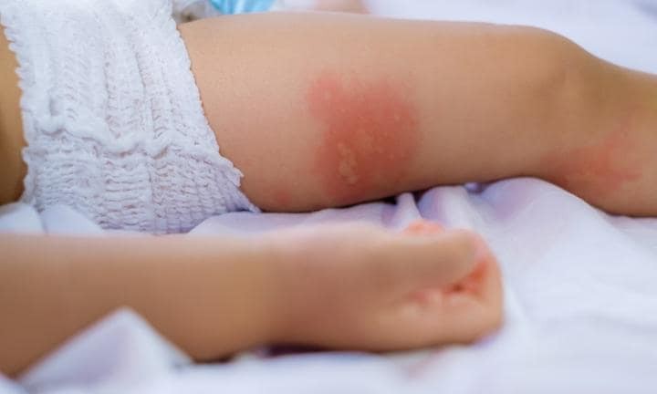 Đây chính là điều cha mẹ nên lo lắng khi con cái thường xuyên bị muỗi đốt - Ảnh 1. Đây chính là điều cha mẹ nên lo lắng khi con cái thường xuyên bị muỗi đốt - Ảnh 1.