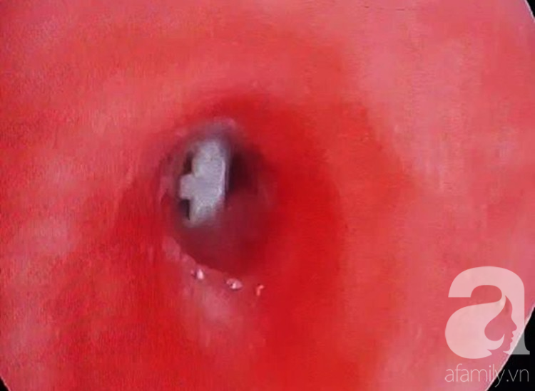 Bé trai 8 tuổi suýt tắc phổi tử vong chỉ vì vô tình's nuốt phải thứ đồ chơi quen thuộc này vào bụng - Ảnh 2. Bé trai 8 tuổi suýt tắc phổi tử vong chỉ vì vô tình's nuốt phải thứ đồ chơi quen thuộc này vào bụng - Ảnh 2.