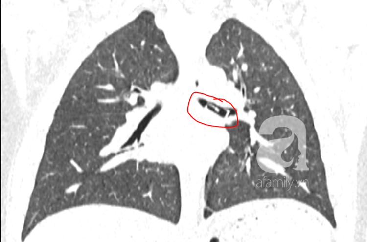 Bé trai 8 tuổi suýt tắc phổi tử vong chỉ vì vô tình's nuốt phải thứ đồ chơi quen thuộc này vào bụng - Ảnh 1. Bé trai 8 tuổi suýt tắc phổi tử vong chỉ vì vô tình's nuốt phải thứ đồ chơi quen thuộc này vào bụng - Ảnh 1.