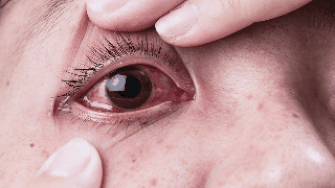 Phân biệt đau mắt đỏ và dị ứng thường gặp vào mùa xuân - Ảnh 2.