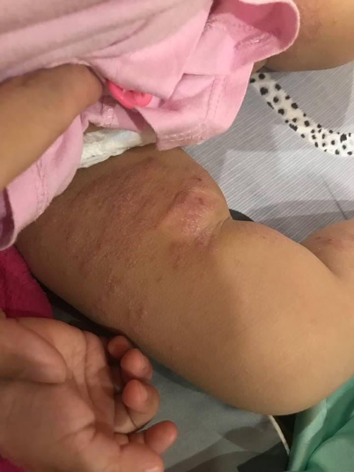 Ròng rã theo con bị viêm da cơ địa, gãi trày da tróc vảy cũng không hết ngứa, mẹ Hà Nội đúc rút loạt kinh nghiệm xương máu dành cho hội chị em nuôi con nhỏ - Ảnh 3. Ròng rã theo con bị viêm da cơ địa, gãi trày da tróc vảy cũng không hết ngứa, mẹ Hà Nội đúc rút loạt kinh nghiệm xương máu dành cho hội chị em nuôi con nhỏ - Ảnh 3.