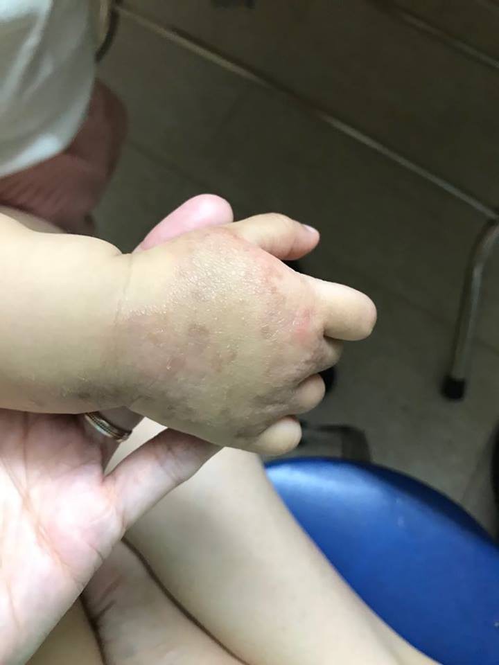 Ròng rã theo con bị viêm da cơ địa, gãi trày da tróc vảy cũng không hết ngứa, mẹ Hà Nội đúc rút loạt kinh nghiệm xương máu dành cho hội chị em nuôi con nhỏ - Ảnh 7. Ròng rã theo con bị viêm da cơ địa, gãi trày da tróc vảy cũng không hết ngứa, mẹ Hà Nội đúc rút loạt kinh nghiệm xương máu dành cho hội chị em nuôi con nhỏ - Ảnh 7.