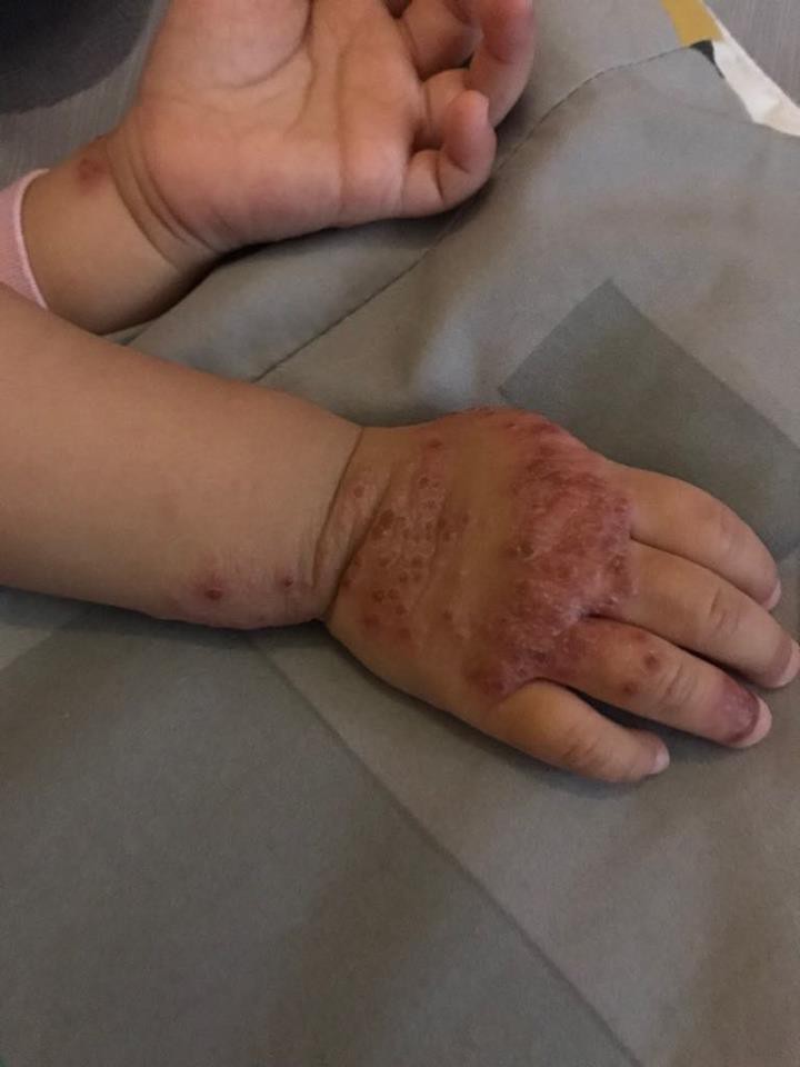 Ròng rã theo con bị viêm da cơ địa, gãi trày da tróc vảy cũng không hết ngứa, mẹ Hà Nội đúc rút loạt kinh nghiệm xương máu dành cho hội chị em nuôi con nhỏ - Ảnh 4. Ròng rã theo con bị viêm da cơ địa, gãi trày da tróc vảy cũng không hết ngứa, mẹ Hà Nội đúc rút loạt kinh nghiệm xương máu dành cho hội chị em nuôi con nhỏ - Ảnh 4.