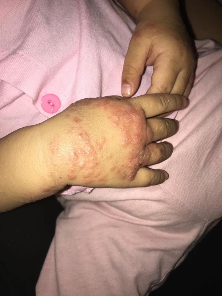 Ròng rã theo con bị viêm da cơ địa, gãi trày da tróc vảy cũng không hết ngứa, mẹ Hà Nội đúc rút loạt kinh nghiệm xương máu dành cho hội chị em nuôi con nhỏ - Ảnh 5. Ròng rã theo con bị viêm da cơ địa, gãi trày da tróc vảy cũng không hết ngứa, mẹ Hà Nội đúc rút loạt kinh nghiệm xương máu dành cho hội chị em nuôi con nhỏ - Ảnh 5.