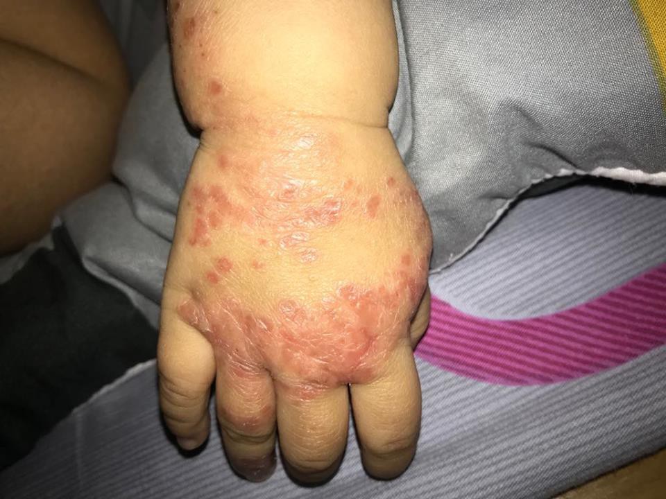 Ròng rã theo con bị viêm da cơ địa, gãi trày da tróc vảy cũng không hết ngứa, mẹ Hà Nội đúc rút loạt kinh nghiệm xương máu dành cho hội chị em nuôi con nhỏ - Ảnh 1. Ròng rã theo con bị viêm da cơ địa, gãi trày da tróc vảy cũng không hết ngứa, mẹ Hà Nội đúc rút loạt kinh nghiệm xương máu dành cho hội chị em nuôi con nhỏ - Ảnh 1.