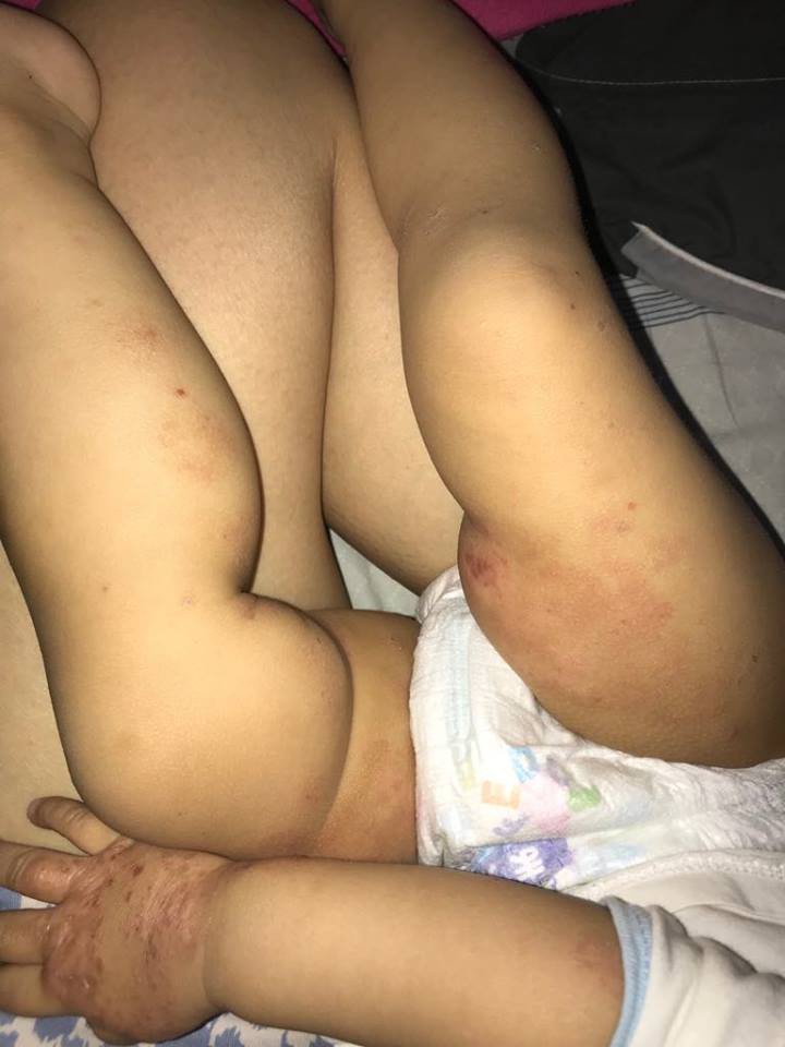 Ròng rã theo con bị viêm da cơ địa, gãi trày da tróc vảy cũng không hết ngứa, mẹ Hà Nội đúc rút loạt kinh nghiệm xương máu dành cho hội chị em nuôi con nhỏ - Ảnh 8. Ròng rã theo con bị viêm da cơ địa, gãi trày da tróc vảy cũng không hết ngứa, mẹ Hà Nội đúc rút loạt kinh nghiệm xương máu dành cho hội chị em nuôi con nhỏ - Ảnh 8.