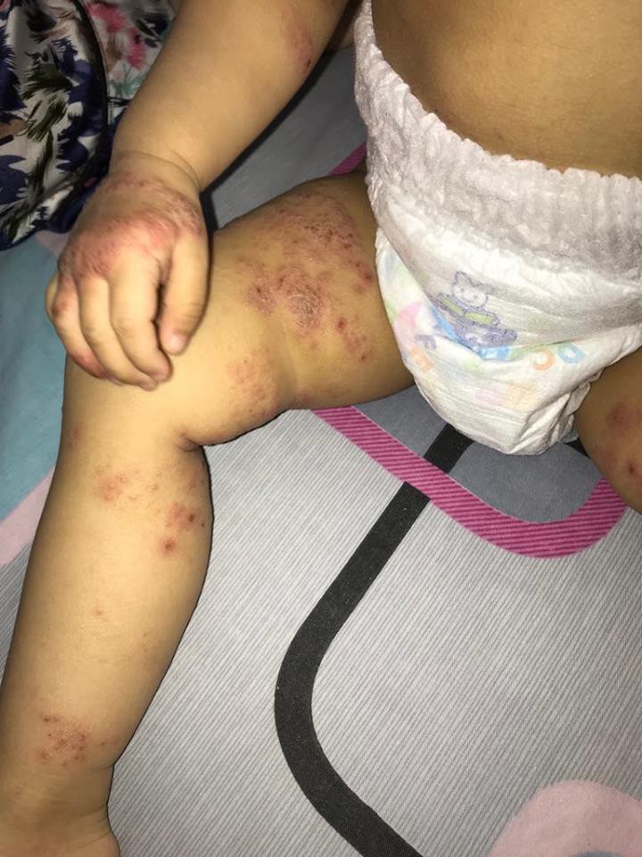 Ròng rã theo con bị viêm da cơ địa, gãi trày da tróc vảy cũng không hết ngứa, mẹ Hà Nội đúc rút loạt kinh nghiệm xương máu dành cho hội chị em nuôi con nhỏ - Ảnh 6. Ròng rã theo con bị viêm da cơ địa, gãi trày da tróc vảy cũng không hết ngứa, mẹ Hà Nội đúc rút loạt kinh nghiệm xương máu dành cho hội chị em nuôi con nhỏ - Ảnh 6.