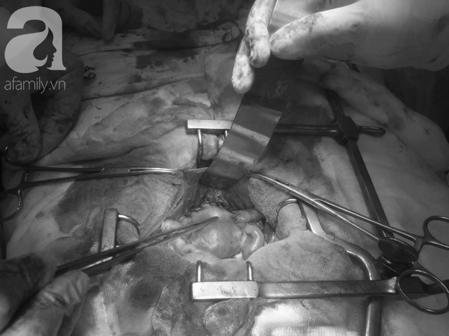 Sốc: Vừa có kỳ kinh nguyệt đầu tiên, bé gái 14 tuổi ở Bình Dương đã phát hiện ung thư tử cung thời kỳ cuối - Ảnh 4. Sốc: Vừa có kỳ kinh nguyệt đầu tiên, bé gái 14 tuổi ở Bình Dương đã phát hiện ung thư tử cung thời kỳ cuối - Ảnh 4.