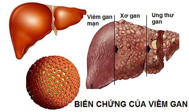 Bệnh gan rất nguy hiểm vì gây tử vong sớm: Chuyên gia ung thư gan chỉ cách phòng ngừa đúng - Ảnh 1. Bệnh gan rất nguy hiểm vì gây tử vong sớm: Chuyên gia ung thư gan chỉ cách phòng ngừa đúng - Ảnh 1.