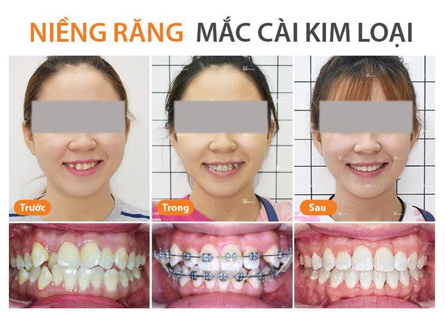 N&ecirc;n niềng răng mắc c&agrave;i sứ hay niềng răng mắc c&agrave;i kim loại - Ảnh 2.