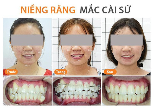N&ecirc;n niềng răng mắc c&agrave;i sứ hay niềng răng mắc c&agrave;i kim loại - Ảnh 3.