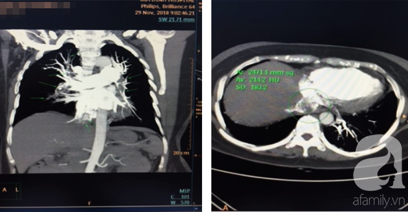 Sản phụ sinh con 4 tháng đã mắc bệnh hiểm, nguy cơ tử vong tới 90%: Cảnh báo căn bệnh đe dọa tính mạng phụ nữ mang thai - Ảnh 5. Sản phụ sinh con 4 tháng đã mắc bệnh hiểm, nguy cơ tử vong tới 90%: Cảnh báo căn bệnh đe dọa tính mạng phụ nữ mang thai - Ảnh 5.