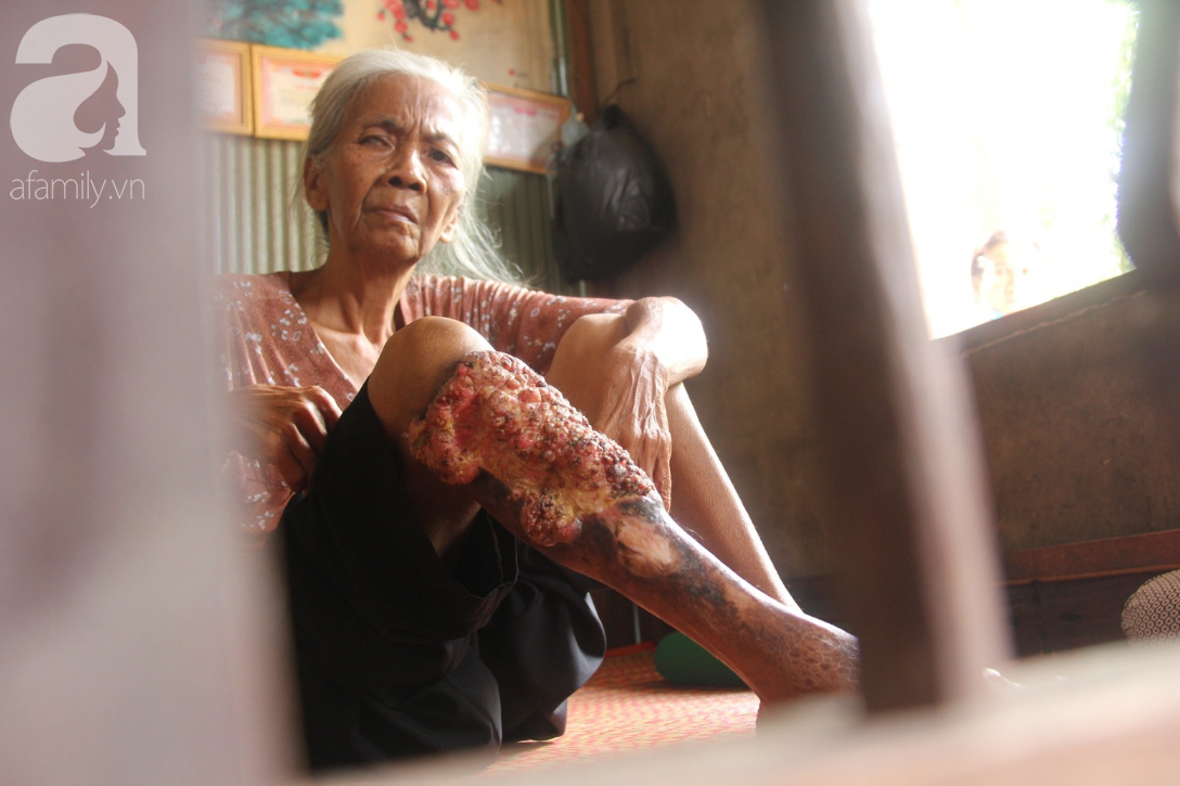 Lời khẩn cầu của người bà 70 tuổi mù một bên mắt, chân bị hoại tử, thối rữa nặng mà không có tiền phẫu thuật - Ảnh 2.