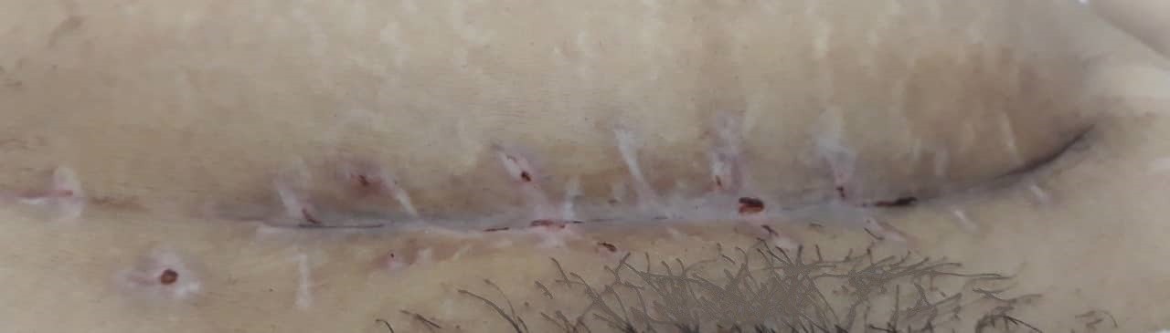 Mẹ Hà Nội kể chuyện bị nhiễm trùng vết mổ sau sinh phải vét mủ nhiều lần, hội chị em chưa chồng nghe xong không dám đẻ - Ảnh 5. Mẹ Hà Nội kể chuyện bị nhiễm trùng vết mổ sau sinh phải vét mủ nhiều lần, hội chị em chưa chồng nghe xong không dám đẻ - Ảnh 5.