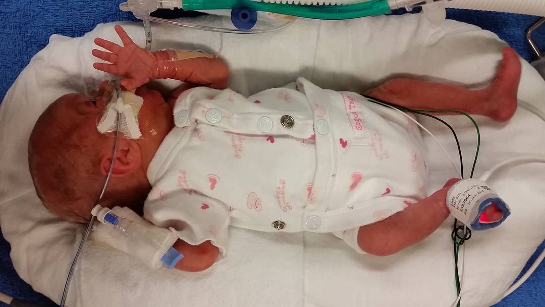 Em bé sinh non 14 tuần, nặng chưa đầy 0,5kg và hành trình sống sót kỳ diệu lấy đi nước mắt của hàng triệu người - Ảnh 6.