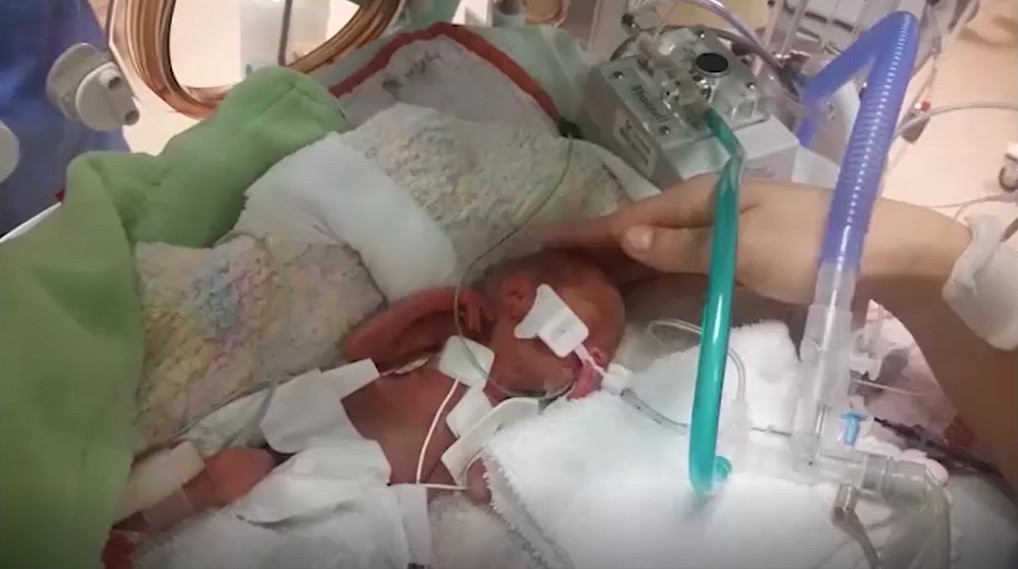 Em bé sinh non 14 tuần, nặng chưa đầy 0,5kg và hành trình sống sót kỳ diệu lấy đi nước mắt của hàng triệu người - Ảnh 3.