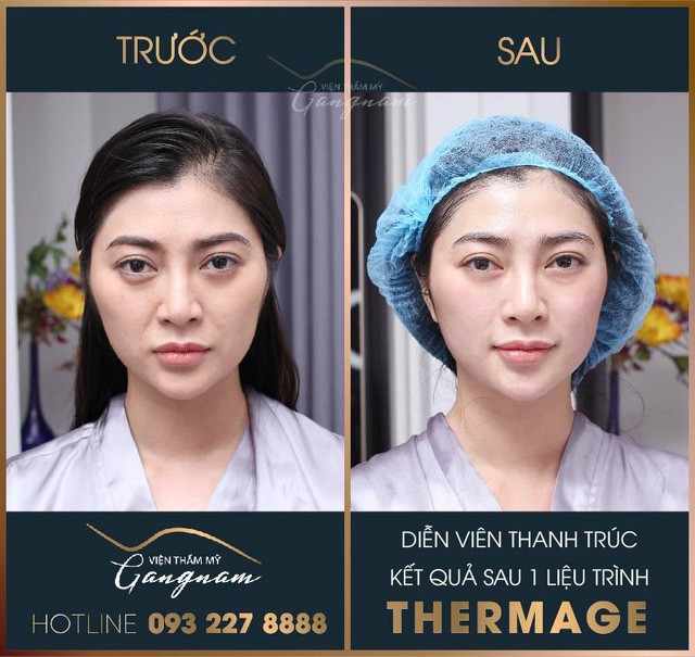 3 nguy hại lớn khi căng da bằng phương pháp Thermage giả, nhái - Ảnh 4. 3 nguy hại lớn khi căng da bằng phương pháp Thermage giả, nhái - Ảnh 4.