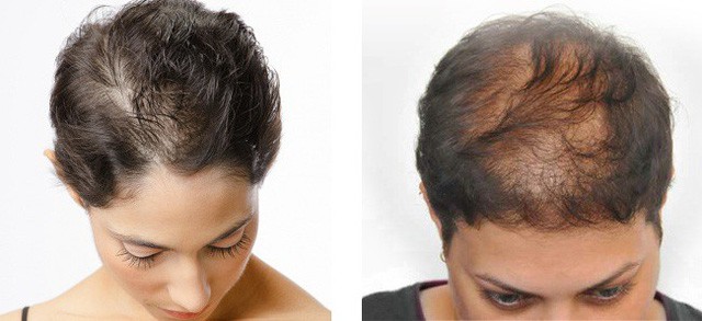 Cách trị rụng tóc: Bạn sẽ chẳng bao giờ phải lo tóc rụng trở lại nếu tránh được những thứ này - Ảnh 2. Cách trị rụng tóc: Bạn sẽ chẳng bao giờ phải lo tóc rụng trở lại nếu tránh được những thứ này - Ảnh 2.
